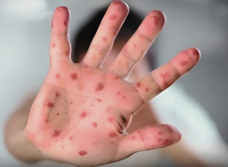 গত ১৯ দিনে হামের উপসর্গে ৯৪ জন শিশুর মৃত্যু হয়েছে এবং বর্তমানে ৯৪৭ জন শিশু হাসপাতালে চিকিৎসাধীন রয়েছে