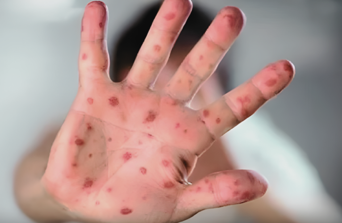 গত ১৯ দিনে হামের উপসর্গে ৯৪ জন শিশুর মৃত্যু হয়েছে এবং বর্তমানে ৯৪৭ জন শিশু হাসপাতালে চিকিৎসাধীন রয়েছে